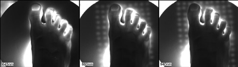 Rys. 4. Porównanie rezultatów prześwietlenia grzbietu prawej stopy Rys. 4. Porównanie rezultatów prześwietlenia grzbietu prawej stopy